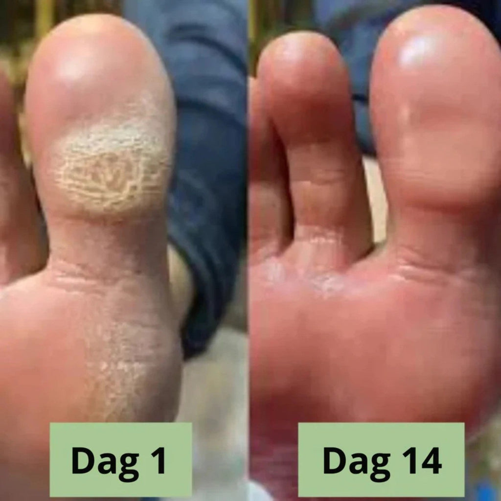 NORDESTO™ Anti-Pilz Seife — Tägliche Pflege gegen Nagelpilz